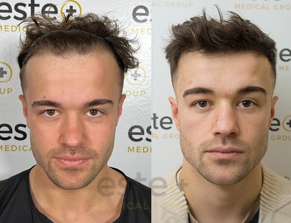Hair Restoration Excellence: Clinics in Istanbul and Turkey